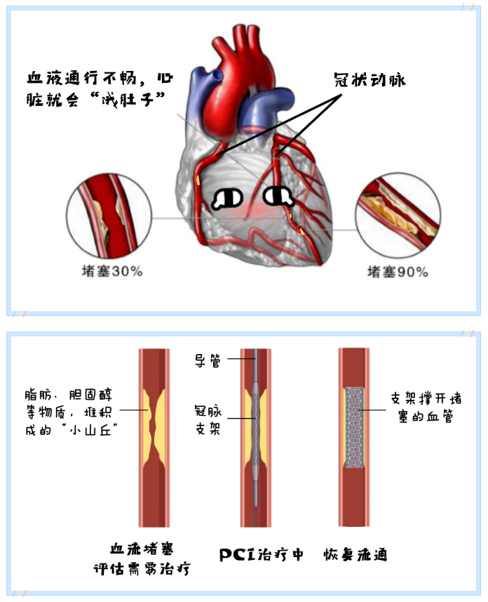 心脏支架的“团购” ——谁说便宜没好货？相关图片